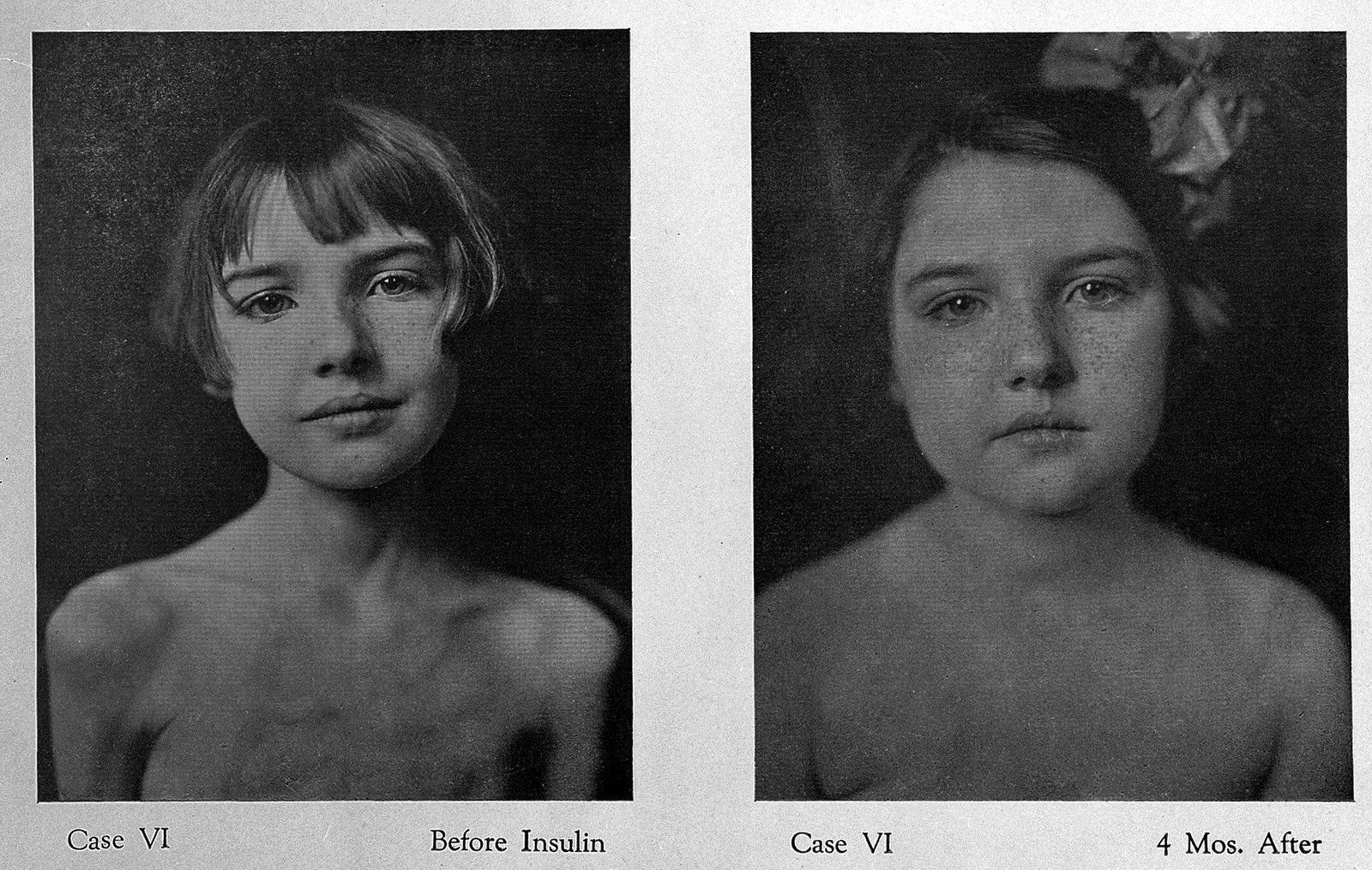 Before and After insulin.jpg